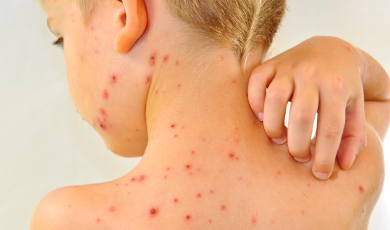 Aumentan casos de varicela en Tamaulipas, ¿sabes cuáles son los síntomas? Aumentan casos de varicela en Tamaulipas, ¿sabes cuáles son los síntomas?