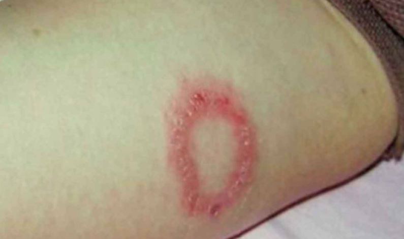 Secretaría de Salud vigila 12 municipios por casos de lepra Secretaría de Salud vigila 12 municipios por casos de lepra