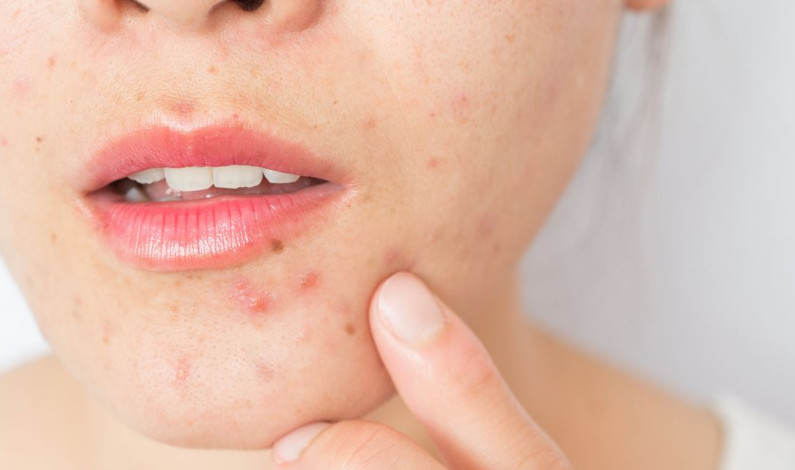 ¿Cómo prevenir espinillas y/o Granitos en el rostro?