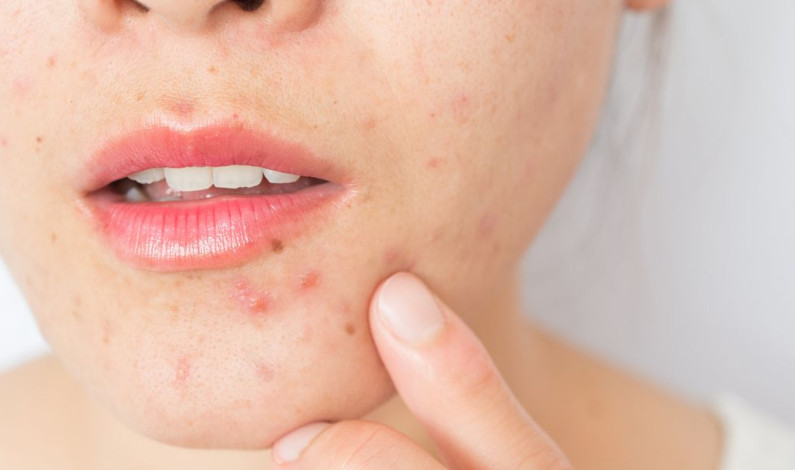 ¿Cómo prevenir espinillas y/o Granitos en el rostro? ¿Cómo prevenir espinillas y/o Granitos en el rostro?